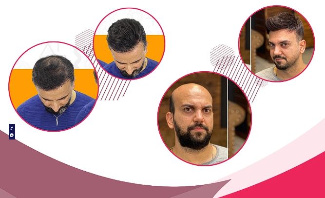 بهترین آرایشگاه های مردانه در اصفهان که باید بشناسید! 4 پروتز مو در آرایشگاه موپیچ